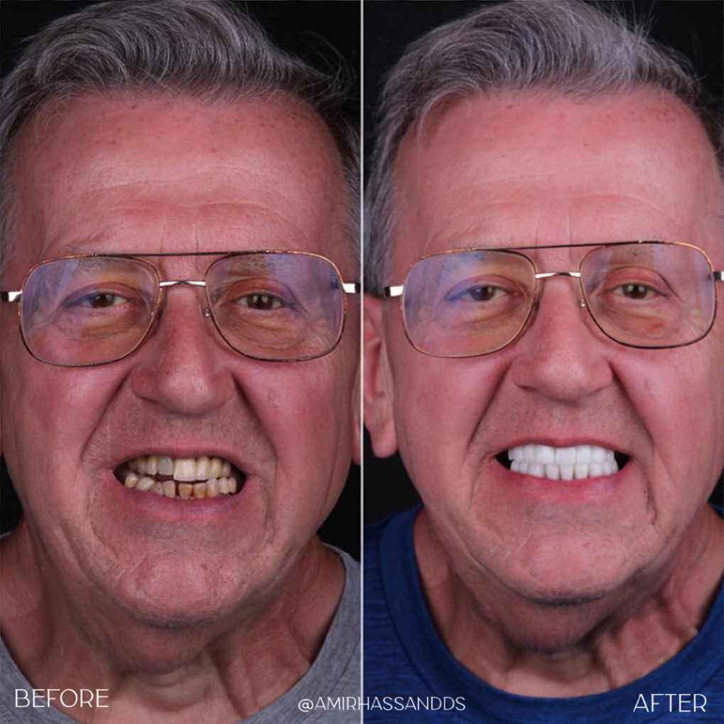 Before After Full Mouth Rehabilitation