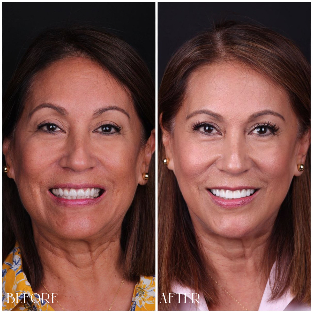 Before After Veneers