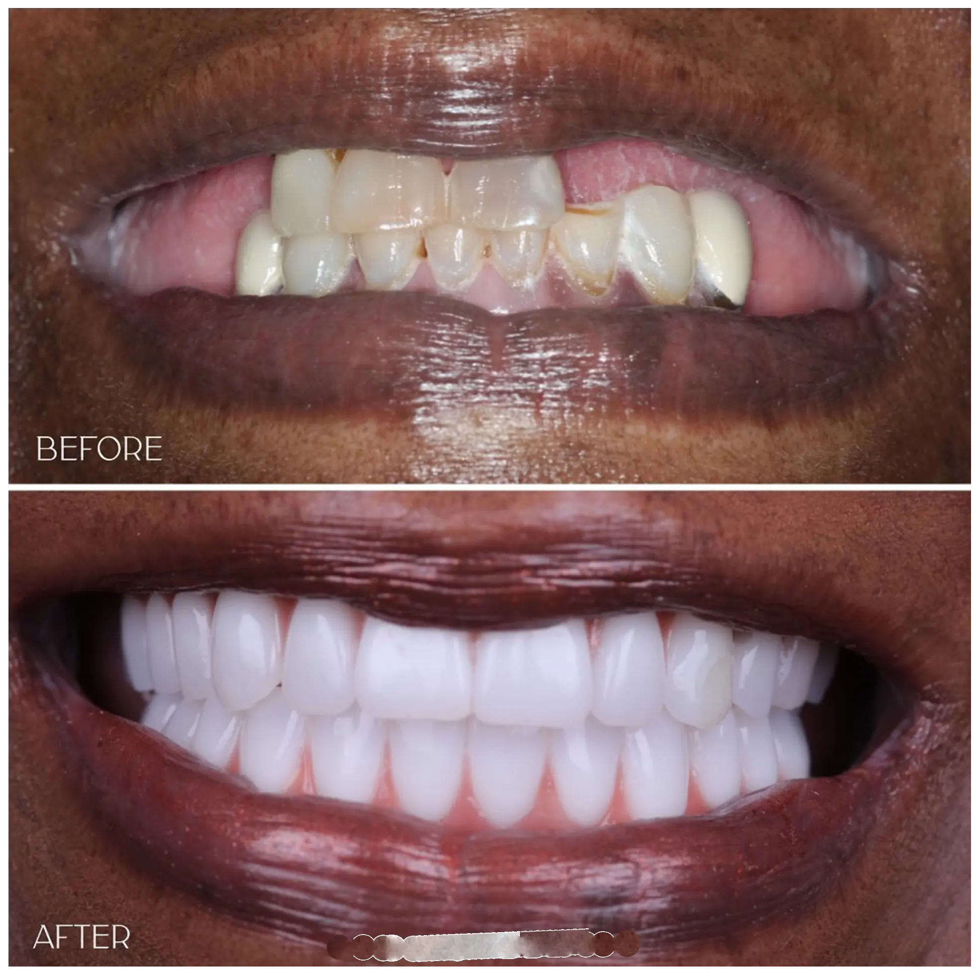Before After Cosmetic Dentistry