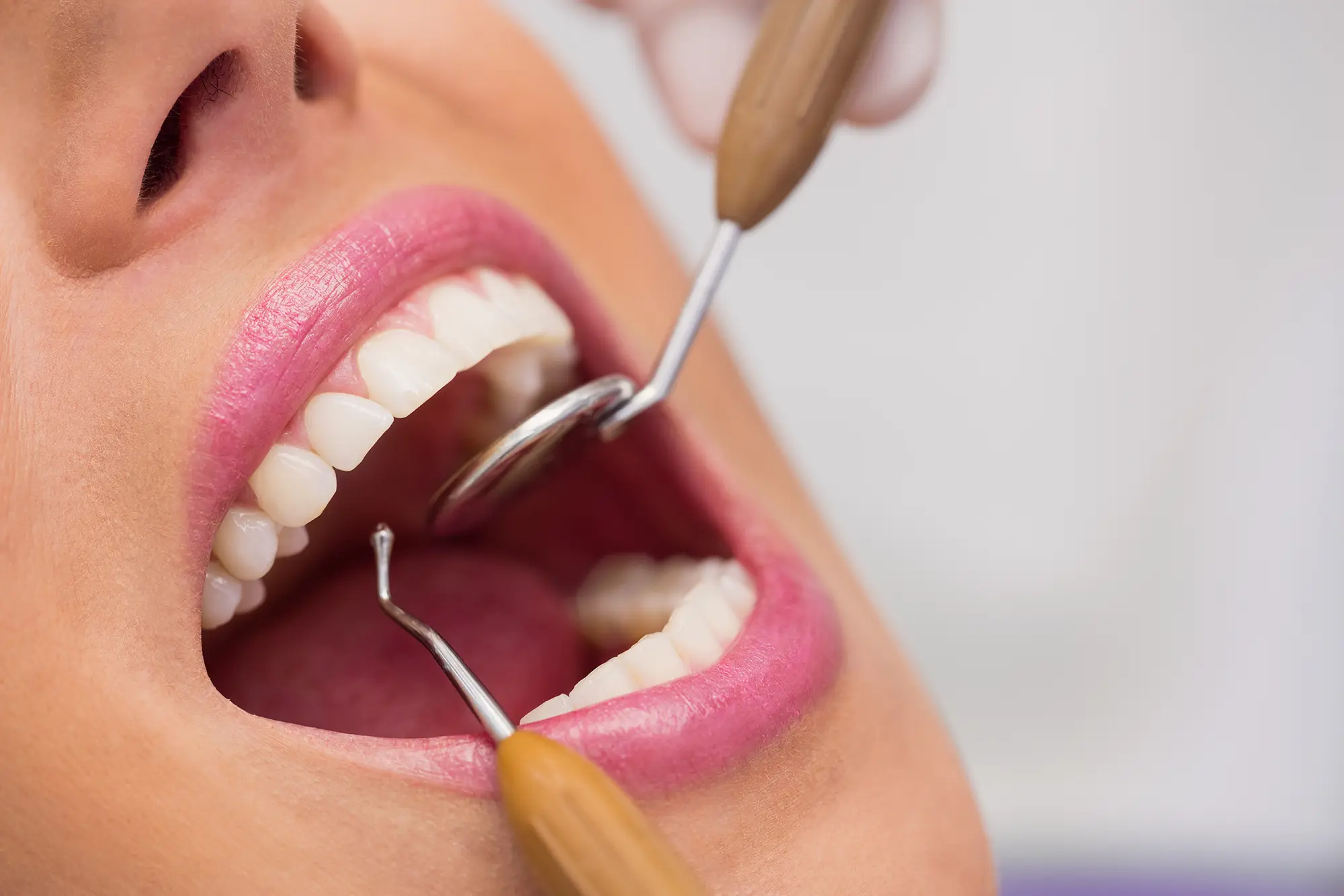Gum Graft in Sugar Land